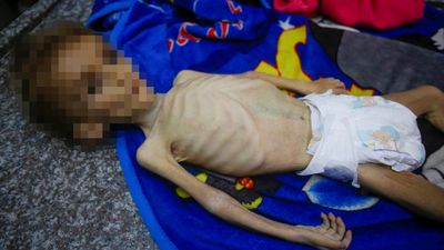Gazze'de bir bebek daha yetersiz beslenmeden hayatını kaybetti