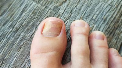 Tırnak mantarına doğal çözüm: 2 malzeme yetiyor, mantardan eser kalmıyor