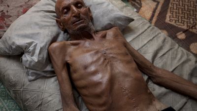 Gazze'de soykırım: 75 yaşındaki adam 40 kiloya düştü