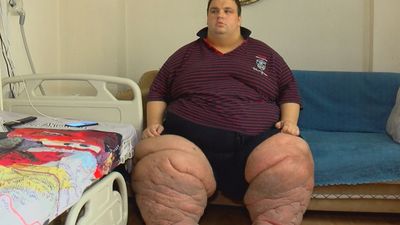 İstanbul'da yaşayan Mehmet, fil hastalığı nedeniyle 270 kiloya çıktı