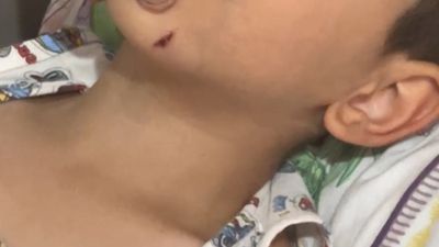 Rize'de başıboş köpek dehşeti: 5 yaşındaki çocuğa saldırdı