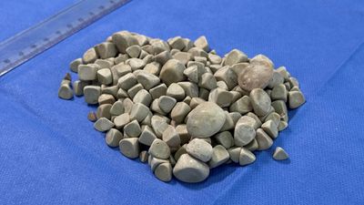 İstanbul'da karın ağrısıyla doktora gitti: Vücudunda 287 tane taş çıktı