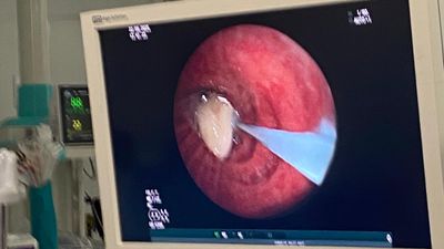 Osmaniye'de hastanın akciğerine kaçan sarımsak, operasyonla çıkarıldı