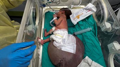 Gazze'de tıbbi malzeme krizi: Bebek Tülin, İsrail abulkasının pençesinde