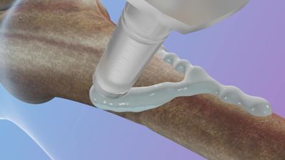 Çinliler geliştirdi: Kemik yapıştırıcısı kırıkları 3 dakikada onarıyor