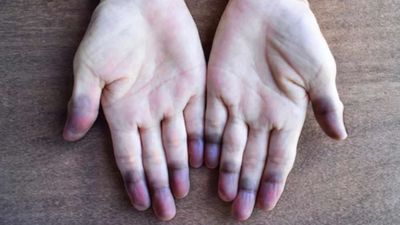 Sigara içenler dikkat: Bu hastalık sinsi ilerliyor, doku kaybına neden oluyor