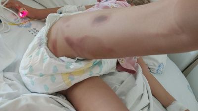 İzmir'de 3 yaşındaki Yaren şifa bulmak için girdiği ameliyattan yanık izleriyle çıktı