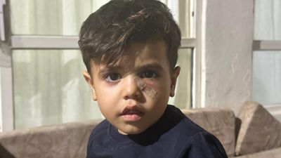 Şanlıurfa'da yorgun mermi çocuğun gözünün altına isabet etti