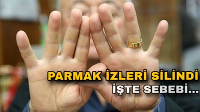 Parmaklarında iz kalmadı: Sebebi şaşırttı