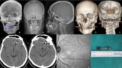 Bursa'da implant tedavisinde vida beynine saplandı: Talihsiz adam, yaşadıklarını anlattı