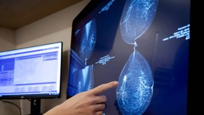 Yeni yapay zeka modeli 5 yıla kadarki meme kanseri riskini tahmin ediyor