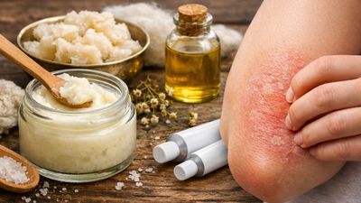 Kuyruk yağı kremi egzama tedavisinde sorun oluşturabilir