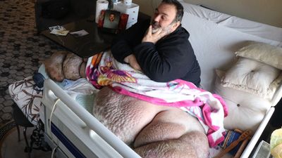 Kayseri'de fil hastası adam 300 kiloya ulaştı: 5 yıldır dışarı çıkamıyor