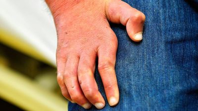 Romanya ve Hırvatistan'da 40 yılın ardından cüzzam vakaları görüldü