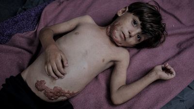 İsrail saldırısının hedefi olan çocuklardan biri: Muhammed