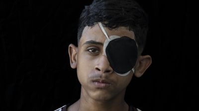 Gazze'de binlerce çocuk İsrail saldırılarında uzuvlarını kaybetti