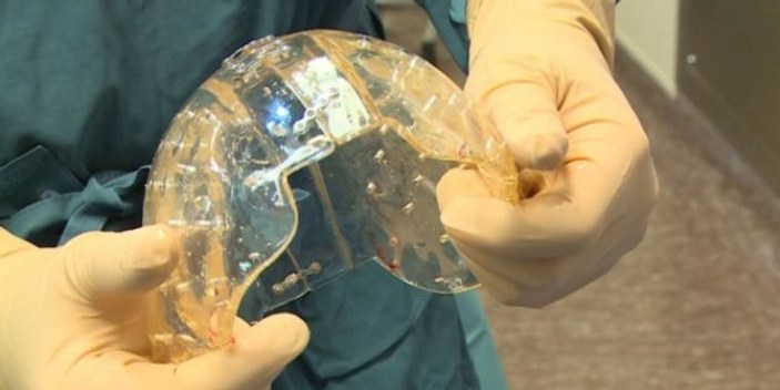 Tıp alanında bir ilk: Plastik kafatası nakli