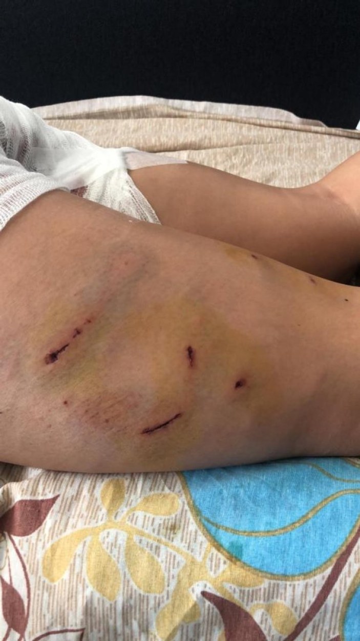 Antalya'da sokak köpeklerinin saldırdığı Endonezyalı kadın ağır yaralandı