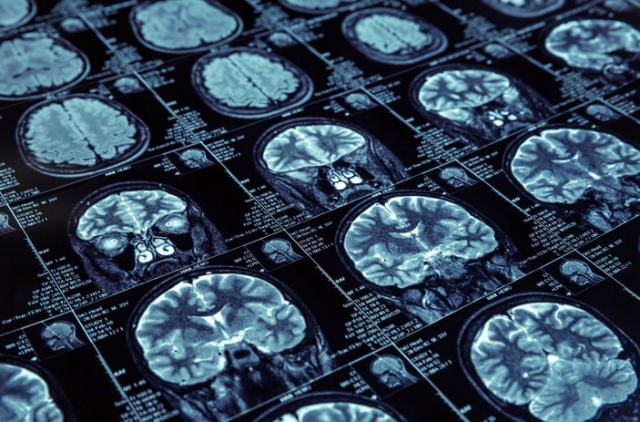 Beyin kanaması belirtileri ve önlemek için ipuçları