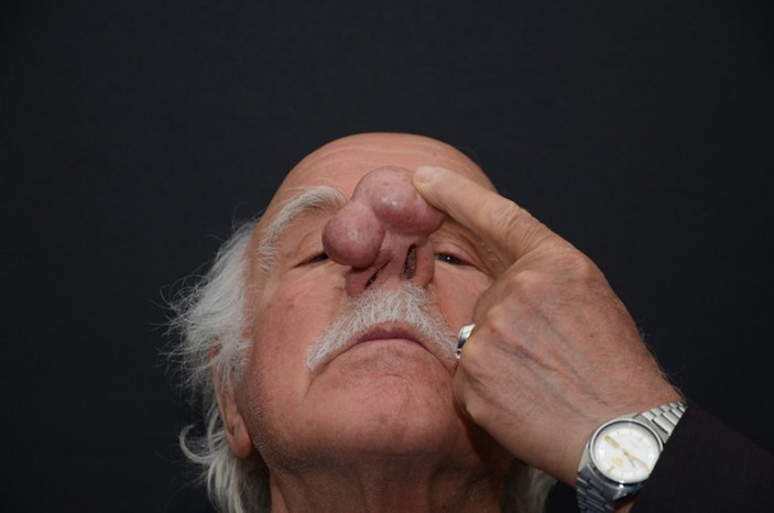 Trabzon'da burnundaki dev kitleyle 2 yıl yaşayan hasta ameliyat oldu