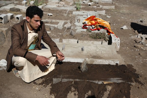 Yemenli yapışık ikizler kurtarılamadı