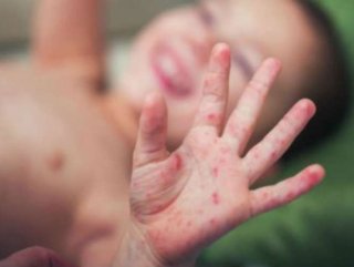 Gürcistan'da kızamık salgını