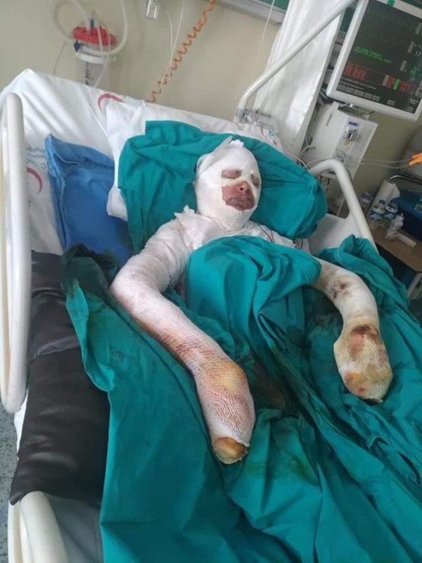 Lise öğrencisi bitlerden kurtulmak isterken tutuştu