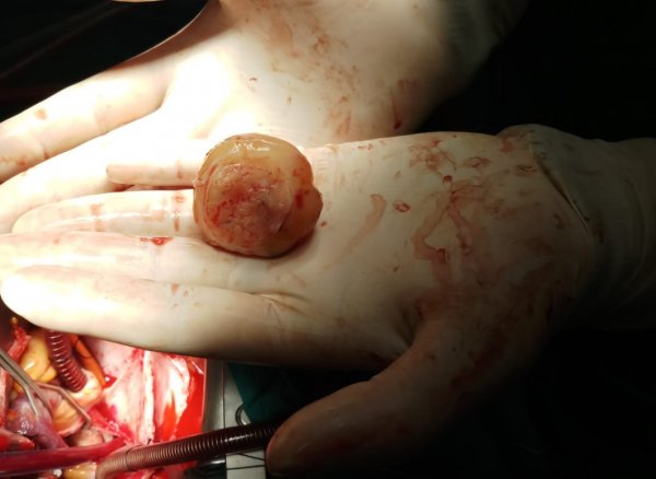 i Talihsiz kadının kalbinden kitle çıkarıldı