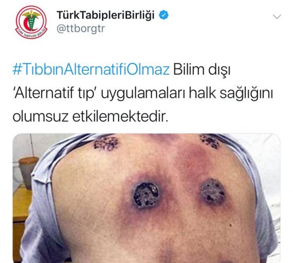 Tabipler Birliği hacamata karşı