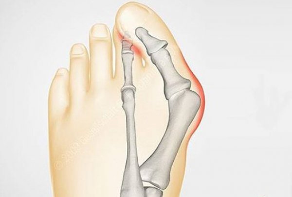 Halluks Valgus nedir