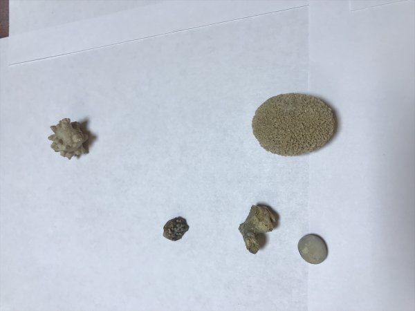 a Hastalarından çıkardığı taşları koleksiyon yaptı