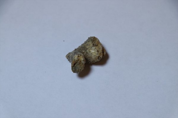 a Hastalarından çıkardığı taşları koleksiyon yaptı