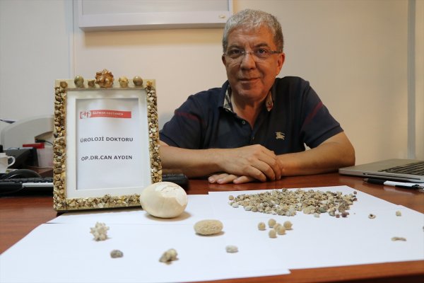 a Hastalarından çıkardığı taşları koleksiyon yaptı