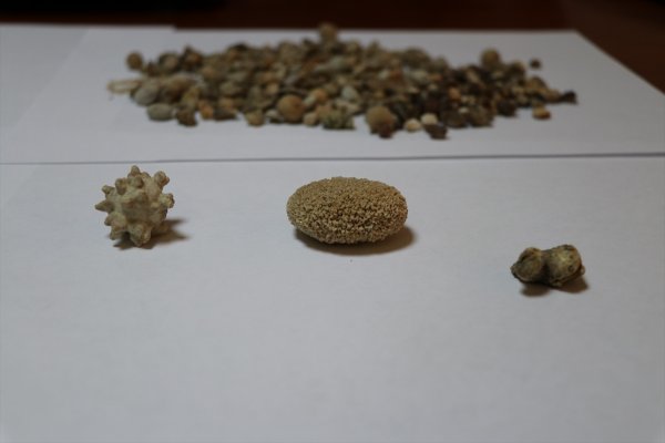 a Hastalarından çıkardığı taşları koleksiyon yaptı