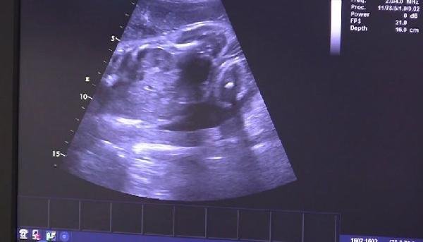 d Çekya'da mucizevi doğum