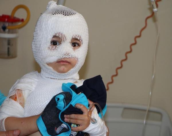 d Erzurum'da 2 yaşındaki çocuğun üzerine kaynar su döküldü