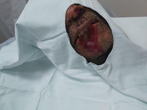 d Pendik'te damat kayınpederinin dudağını parçaladı