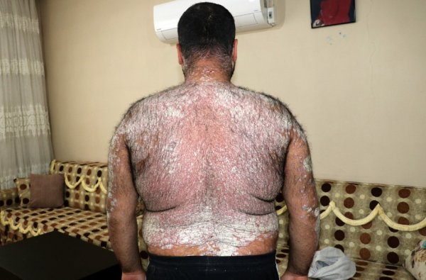 Sedef hastalığına yakalandı, yardım bekliyor