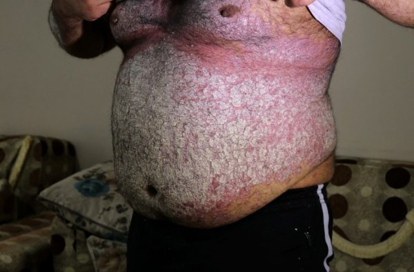 Sedef hastalığına yakalandı, yardım bekliyor