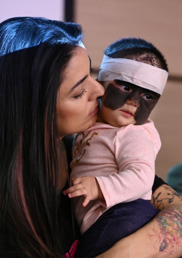 r Nadir görülen cilt hastalığı ile doğdu