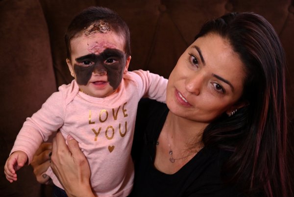 r Nadir görülen cilt hastalığı ile doğdu