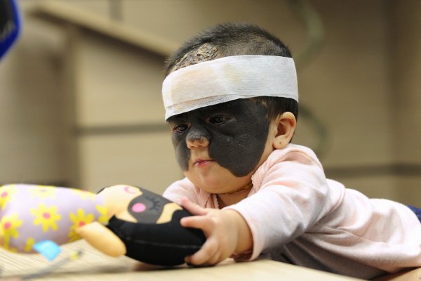 r Nadir görülen cilt hastalığı ile doğdu