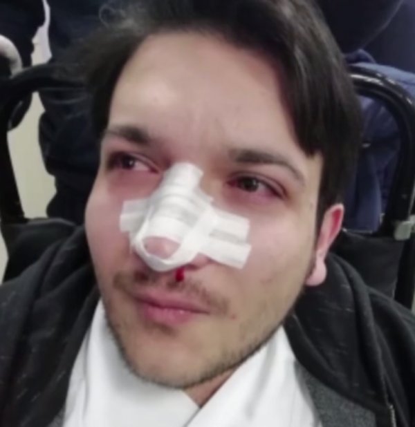 Randevusuz hasta doktorun burnunu kırdı