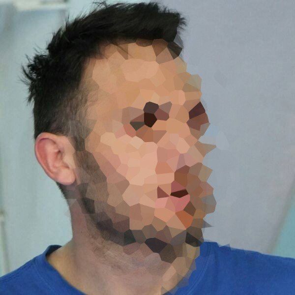 Boks antrenörü kavga ettiği şahsın çenesini kırdı