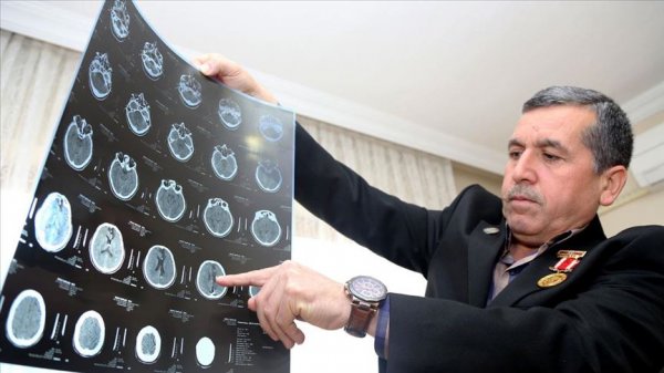 a Gazi, 28 yıldır başındaki 14 şarapnel parçasıyla yaşıyor