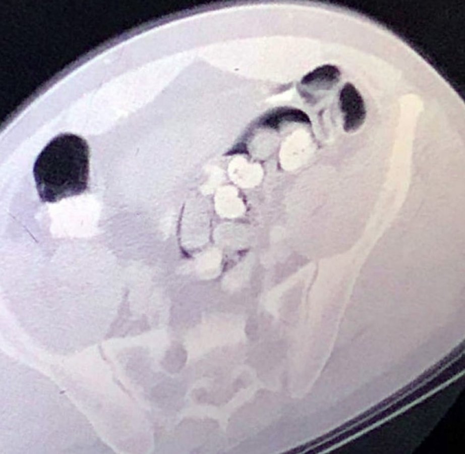 i İranlı bağırsağından çıkan uyuşturucuyu kabul etmedi