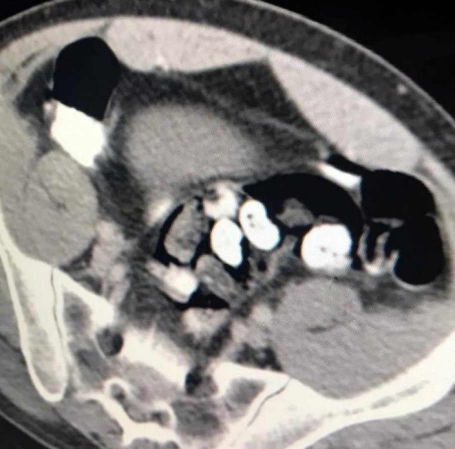 i İranlı bağırsağından çıkan uyuşturucuyu kabul etmedi