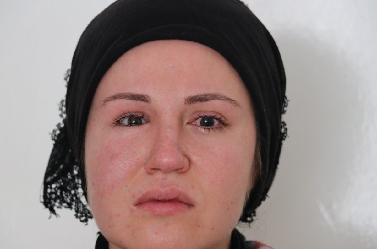 i Eşi tarafından vurulan genç kadın gözünü kaybetti