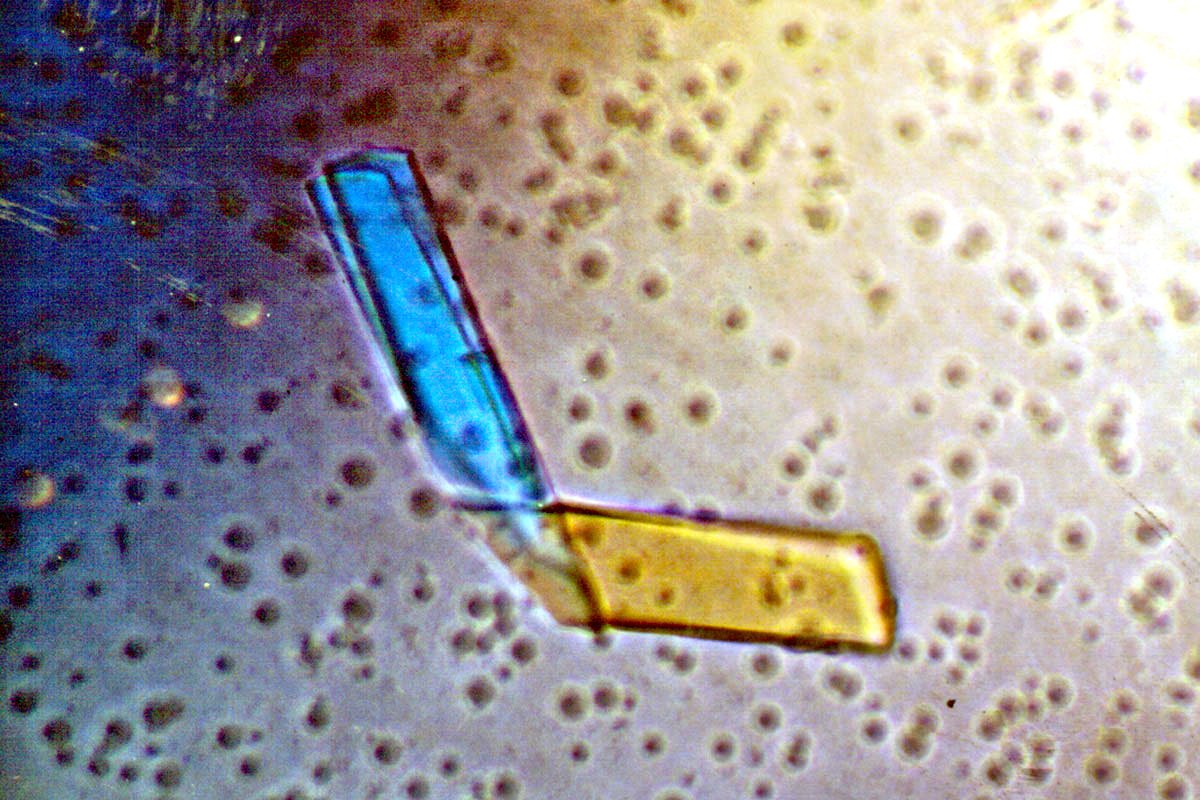 Bence-Jones proteini nedir