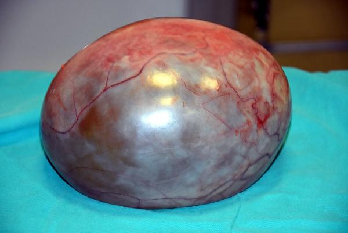 Karın ağrısıyla gittiği hastanede kitleden kurtuldu